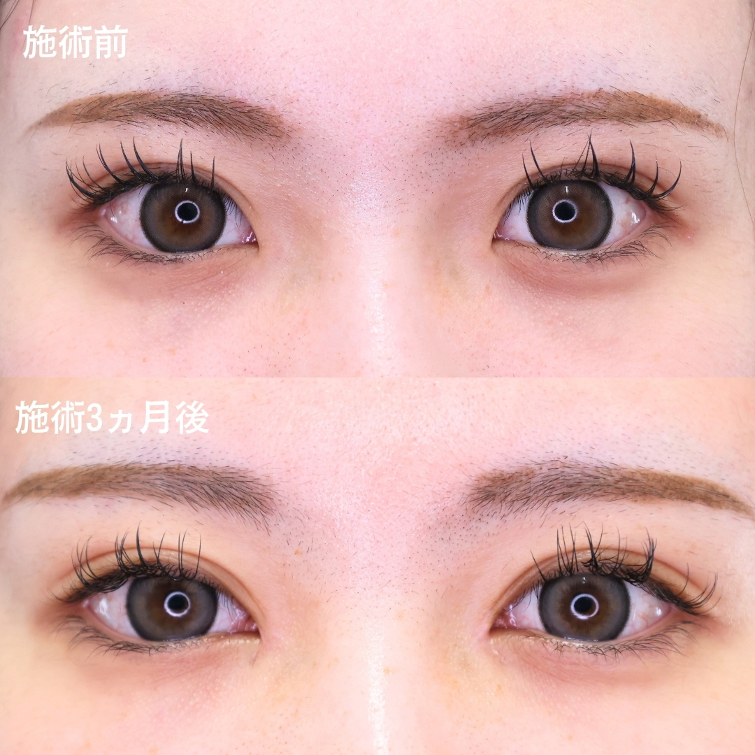 目頭切開術の症例写真 施術前後 