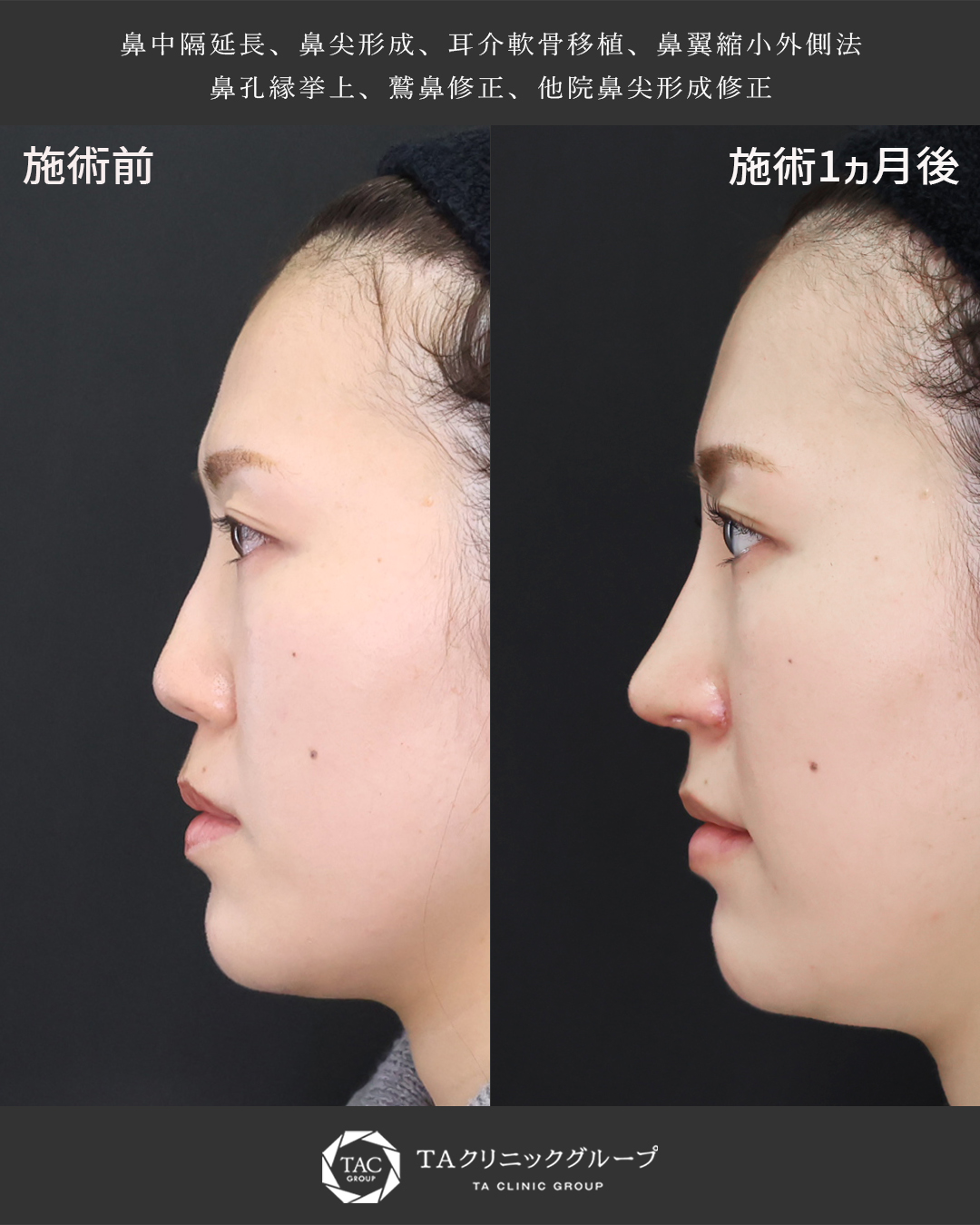 鼻中隔延長術/鼻尖形成・鼻尖縮小/鼻先軟骨移植の症例写真 施術前後 
