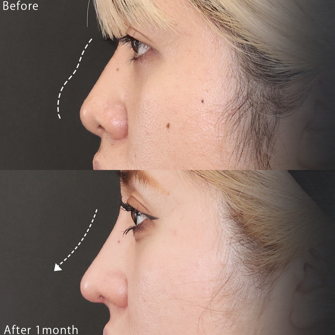 鼻中隔延長術/鼻尖形成・鼻尖縮小/隆鼻術（プロテーゼ・自家組織）の症例写真 施術前後 