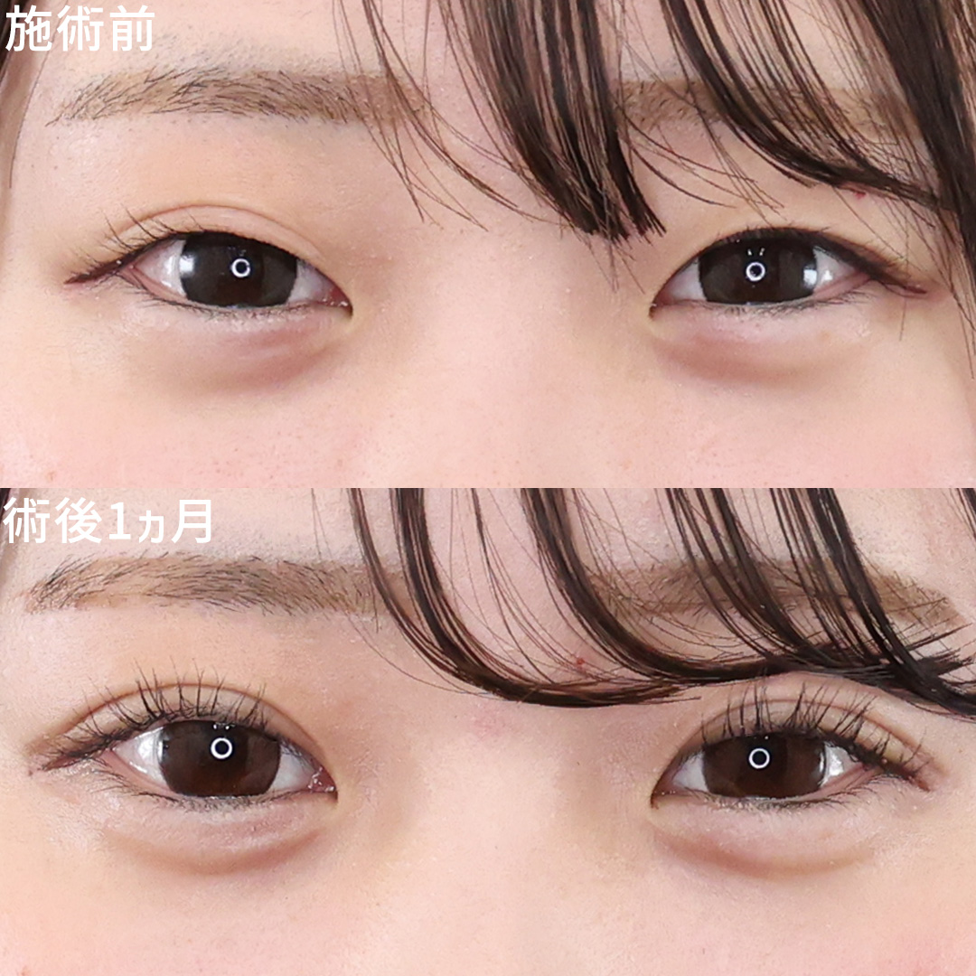 二重埋没法の症例写真 施術前後 