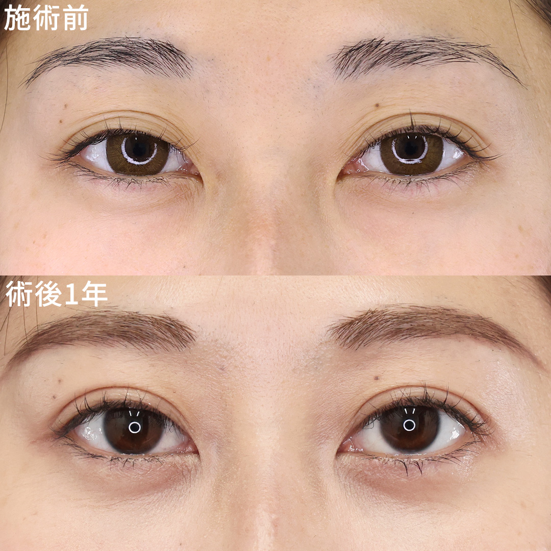 二重埋没法/下眼瞼脱脂術（目の下のたるみ取り・目の下の脂肪ふくらみ取り）の症例写真 施術前後 