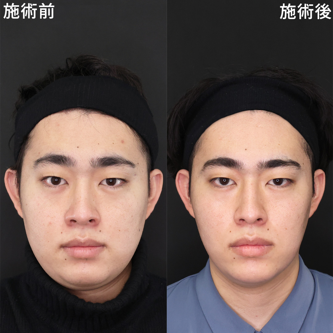 TAC式 ツヤ肌コラーゲンリフト®/顎下の脂肪吸引/Lラインファット除去（エラ下脂肪除去）の症例写真 施術前後 