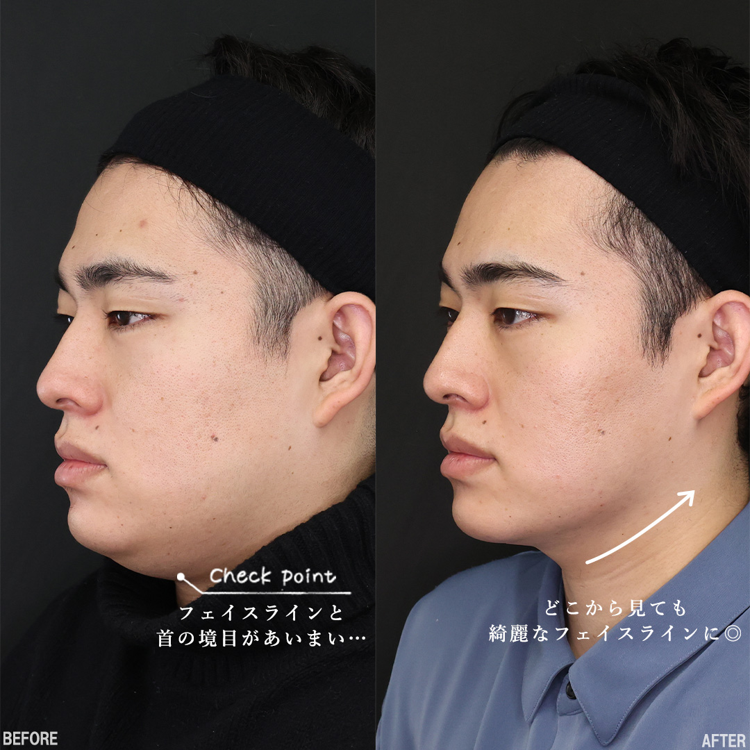 TAC式 ツヤ肌コラーゲンリフト®/顎下の脂肪吸引/Lラインファット除去（エラ下脂肪除去）の症例写真 施術前後 