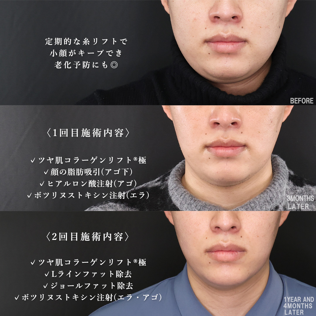 TAC式 ツヤ肌コラーゲンリフト®/顎下の脂肪吸引/Lラインファット除去（エラ下脂肪除去）の症例写真 施術前後 