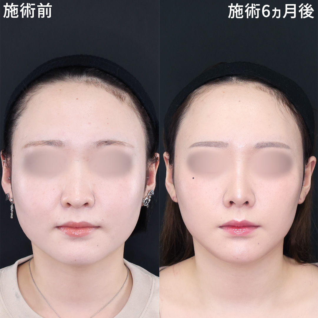 隆鼻術（プロテーゼ・自家組織）/鼻先軟骨移植/鼻尖形成・鼻尖縮小の症例写真 施術前後 