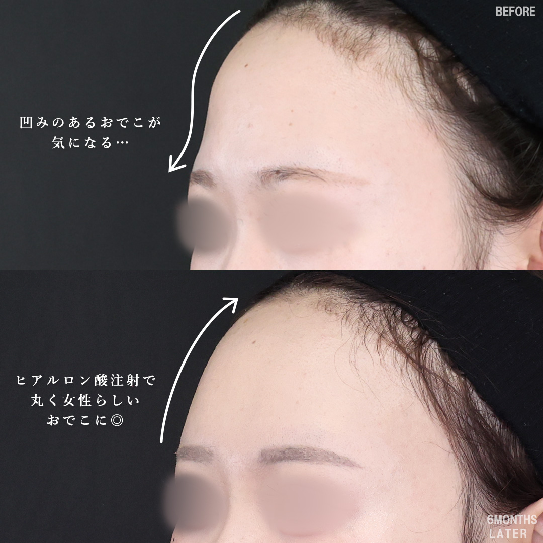 隆鼻術（プロテーゼ・自家組織）/鼻先軟骨移植/鼻尖形成・鼻尖縮小の症例写真 施術前後 