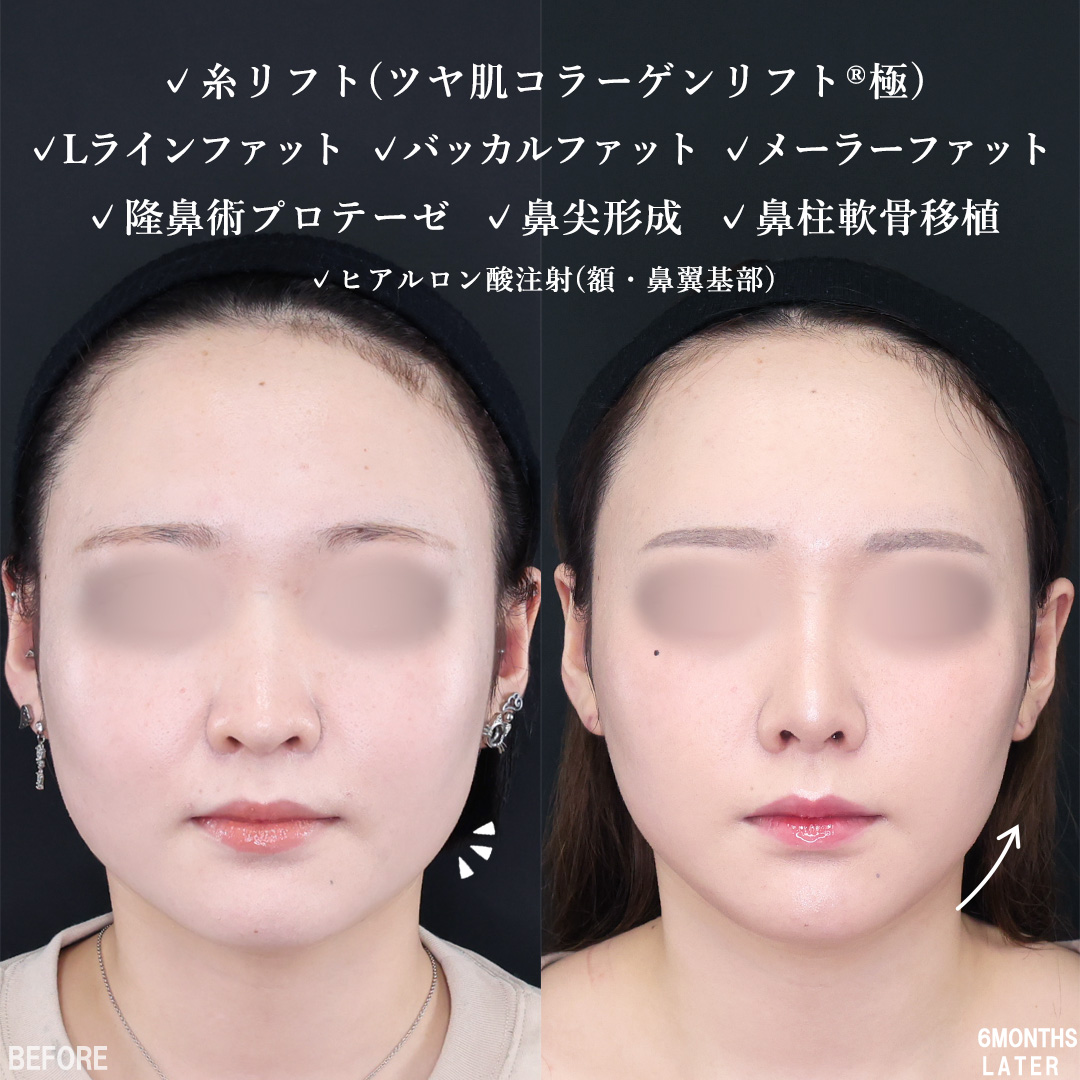 隆鼻術（プロテーゼ・自家組織）/鼻先軟骨移植/鼻尖形成・鼻尖縮小の症例写真 施術前後 