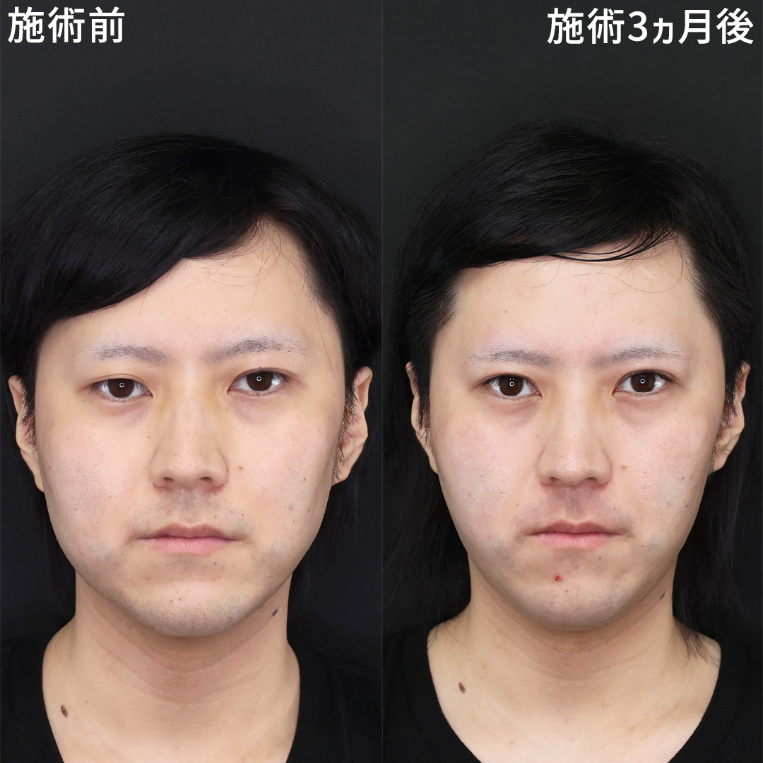 TAC式 ツヤ肌コラーゲンリフト®/メーラーファット除去/顎下の脂肪吸引の症例写真 施術前後 