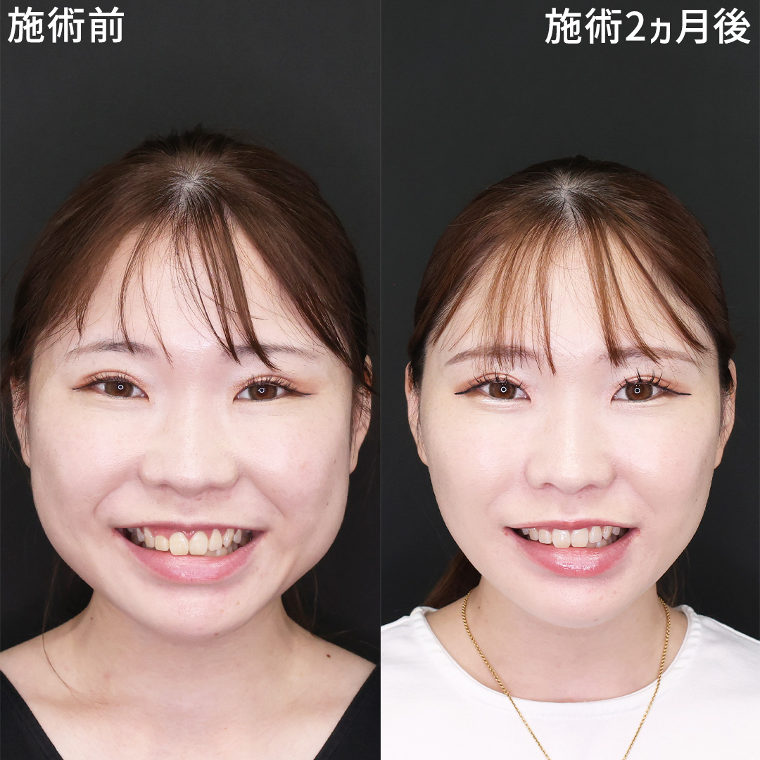 TAC式 ツヤ肌コラーゲンリフト®/ジョールファット除去/バッカルファット除去の症例写真 施術前後 