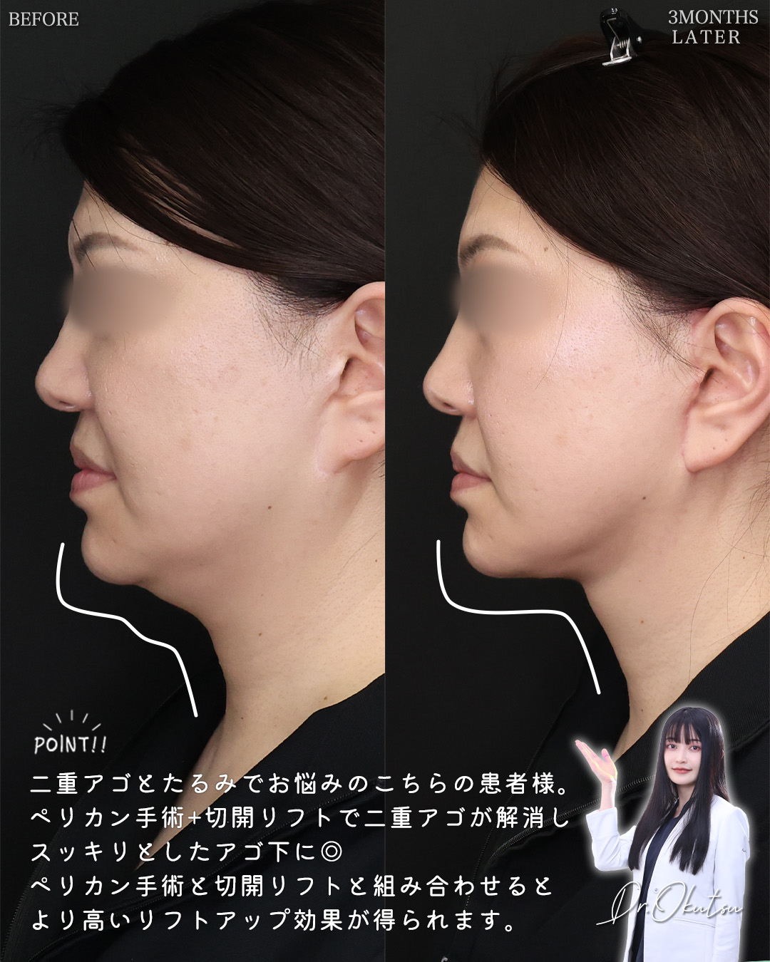フェイスリフト（切開）/TAC式 ツヤ肌コラーゲンリフト®/顎下の脂肪吸引の症例写真 施術前後 