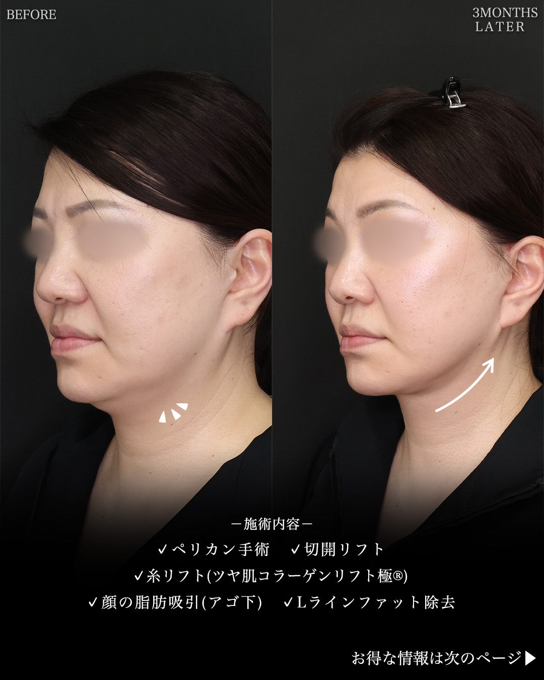 フェイスリフト（切開）/TAC式 ツヤ肌コラーゲンリフト®/顎下の脂肪吸引の症例写真 施術前後 