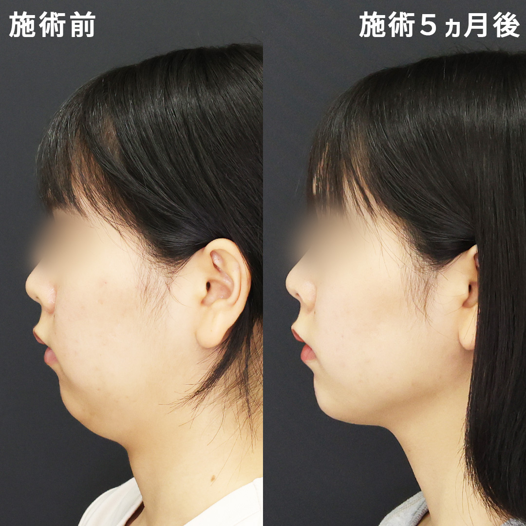 TAC式 ツヤ肌コラーゲンリフト®/顎下の脂肪吸引/ジョールファット除去の症例写真 施術前後 