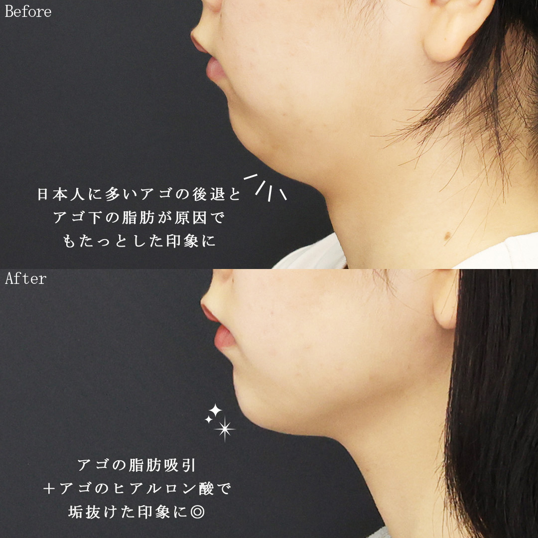 TAC式 ツヤ肌コラーゲンリフト®/顎下の脂肪吸引/ジョールファット除去の症例写真 施術前後 