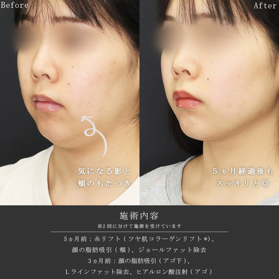 TAC式 ツヤ肌コラーゲンリフト®/顎下の脂肪吸引/ジョールファット除去の症例写真 施術前後 