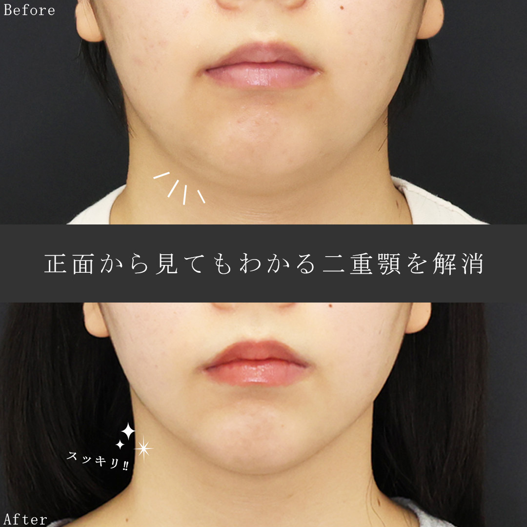 TAC式 ツヤ肌コラーゲンリフト®/顎下の脂肪吸引/ジョールファット除去の症例写真 施術前後 