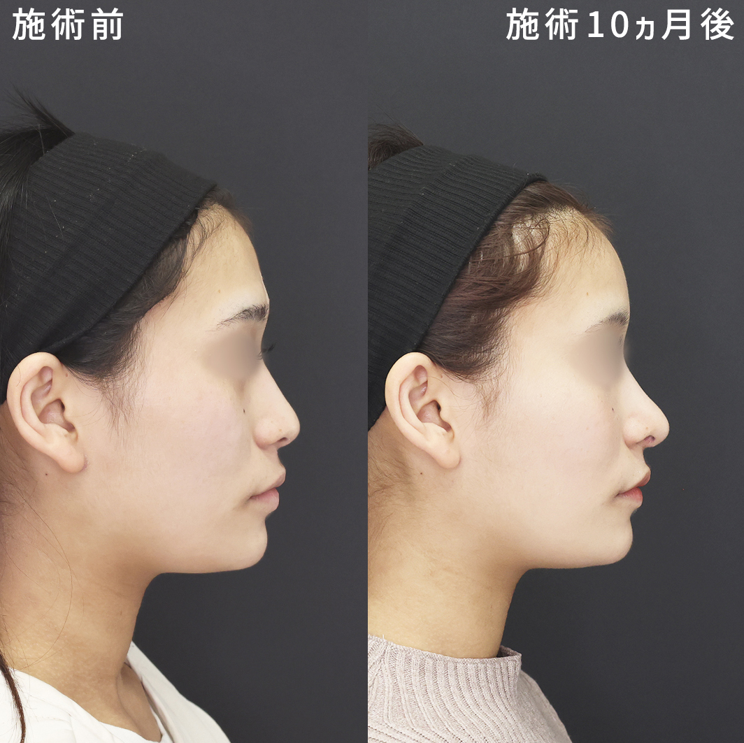 鼻尖形成・鼻尖縮小/鼻先軟骨移植/目の下のヒアルロン酸注射の症例写真 施術前後 