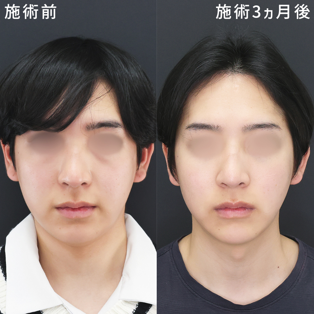 下眼瞼脱脂術（目の下のたるみ取り・目の下の脂肪ふくらみ取り）/ジョールファット除去/顎下の脂肪吸引の症例写真 施術前後 