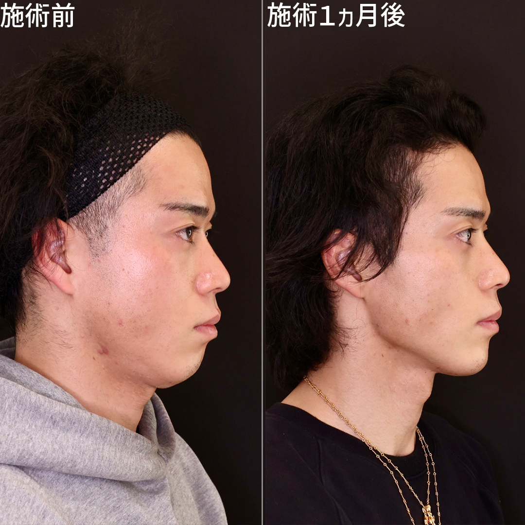 ジョールファット除去/TAC式 ツヤ肌コラーゲンリフト®/顎下の脂肪吸引の症例写真 施術前後 