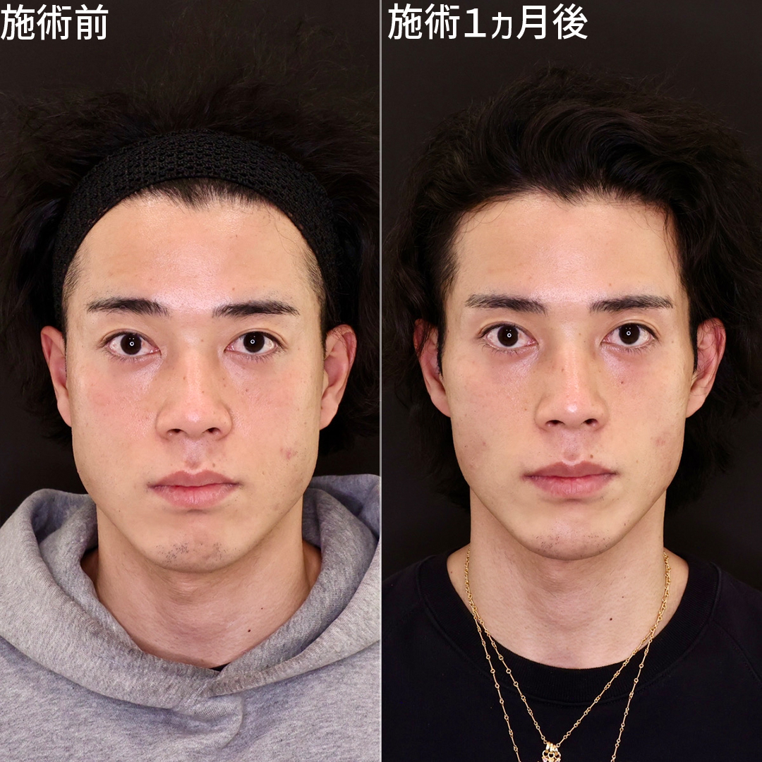 ジョールファット除去/TAC式 ツヤ肌コラーゲンリフト®/顎下の脂肪吸引の症例写真 施術前後 