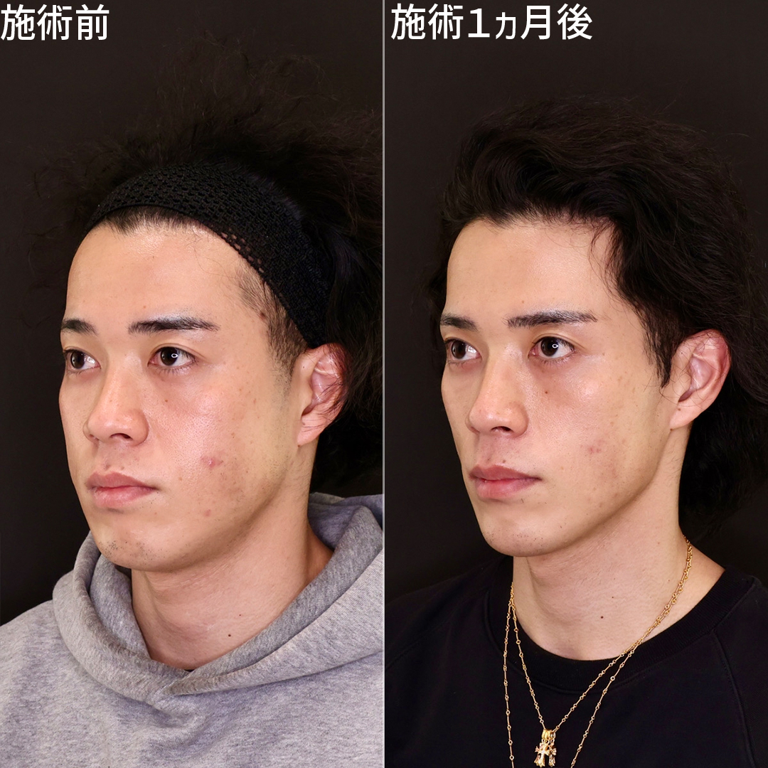 ジョールファット除去/TAC式 ツヤ肌コラーゲンリフト®/顎下の脂肪吸引の症例写真 施術前後 