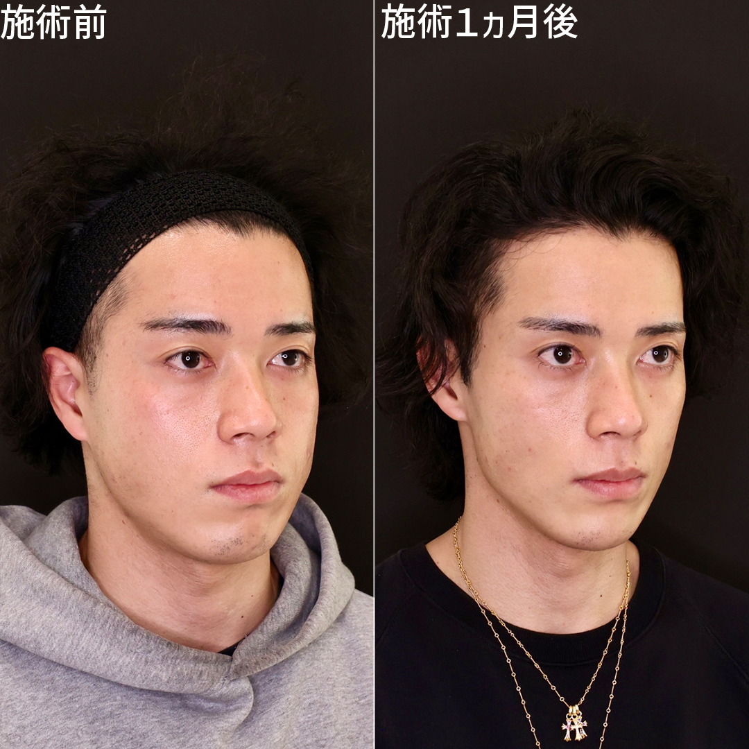ジョールファット除去/TAC式 ツヤ肌コラーゲンリフト®/顎下の脂肪吸引の症例写真 施術前後 