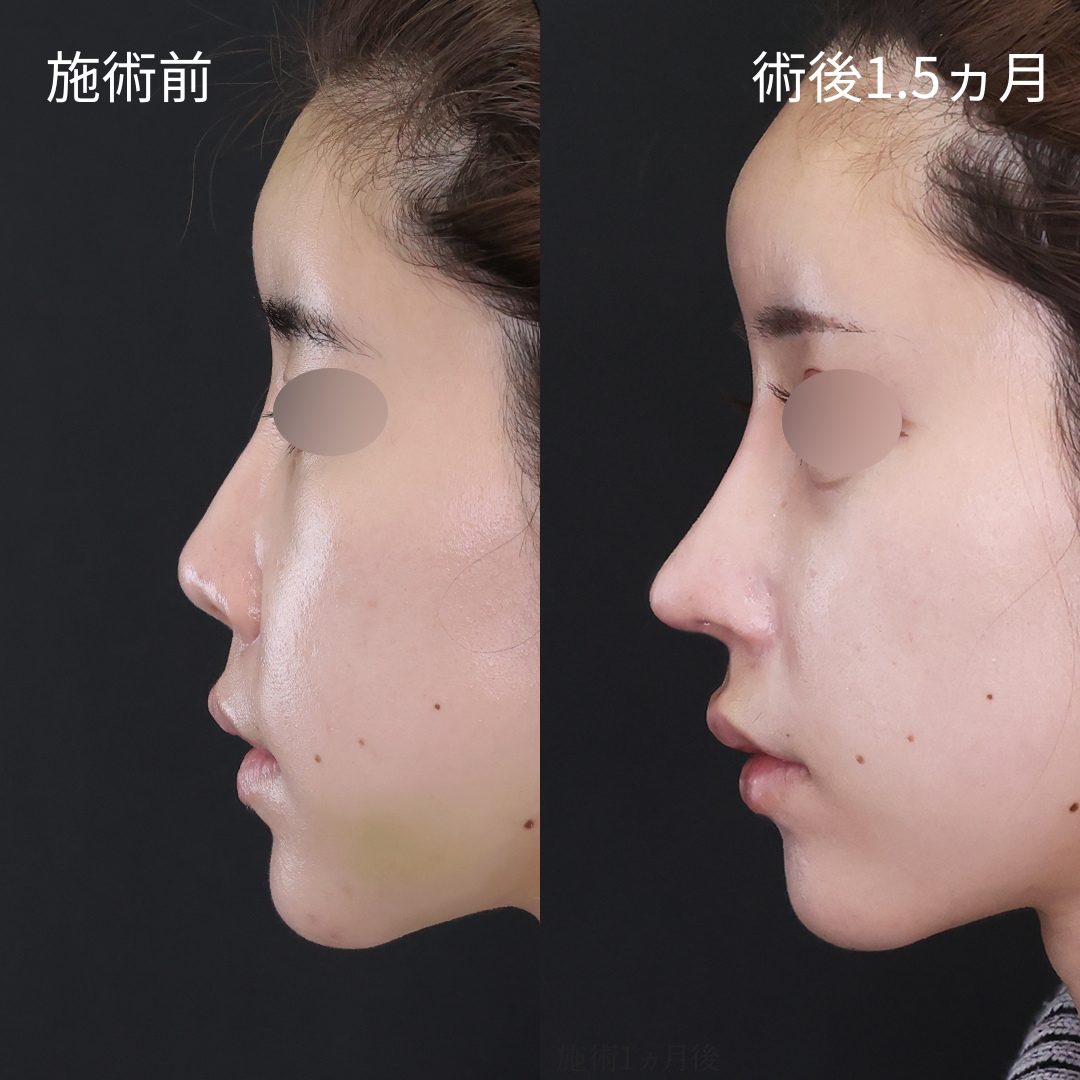 鼻中隔延長術/鼻尖形成・鼻尖縮小/鼻先軟骨移植の症例写真 施術前後 