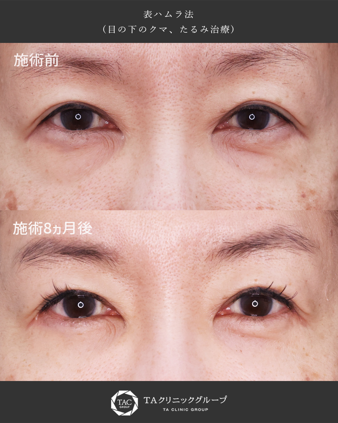 下眼瞼切開術（クマ・たるみとり）の症例写真 施術前後 