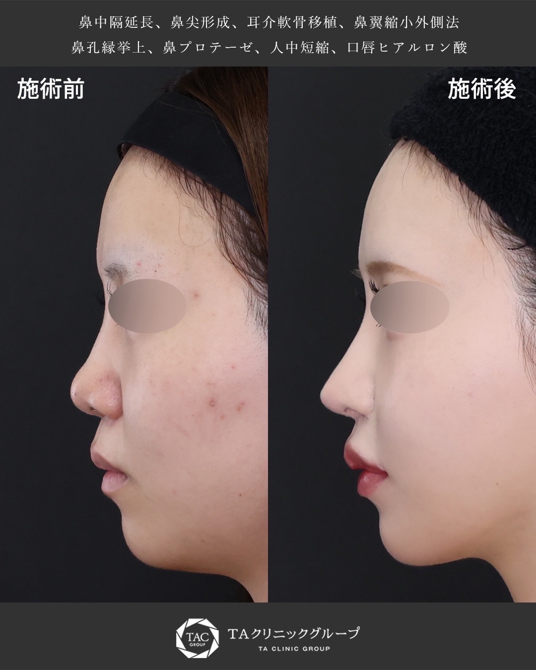 鼻中隔延長術/鼻尖形成・鼻尖縮小/TAC式 鼻翼縮小術（小鼻縮小）の症例写真 施術前後 