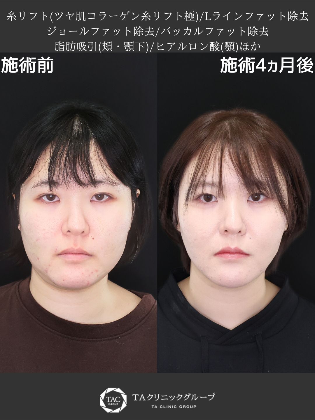 TAC式 ツヤ肌コラーゲンリフト®/Lラインファット除去（エラ下脂肪除去）/ジョールファット除去の症例写真 施術前後 