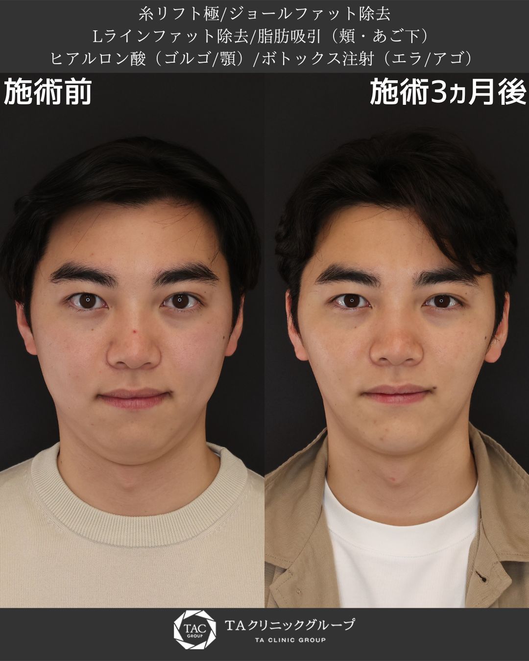 エラボトックス注射/ジョールファット除去/顎下の脂肪吸引の症例写真 施術前後 