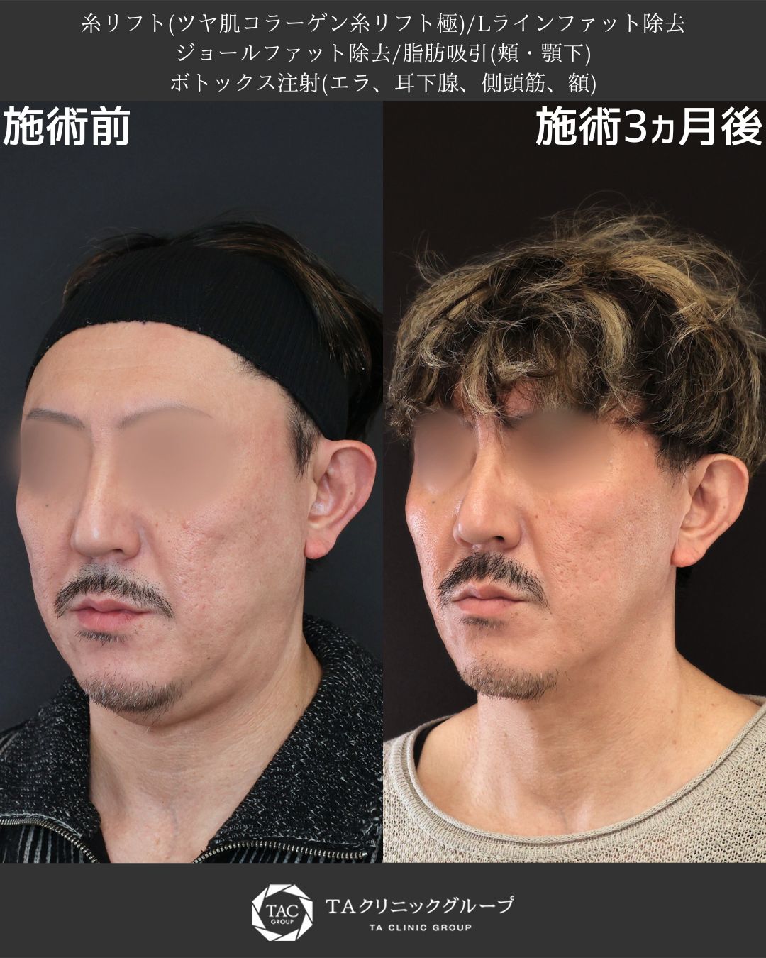 TAC式 ツヤ肌コラーゲンリフト®/Lラインファット除去（エラ下脂肪除去）/ジョールファット除去の症例写真 施術前後 