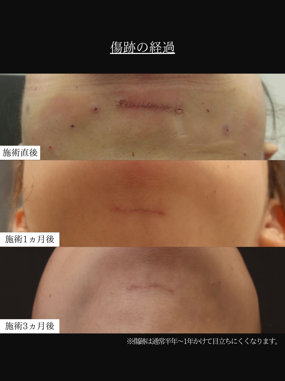 TAC式 ツヤ肌コラーゲンリフト®/顎下の脂肪吸引/顎のヒアルロン酸注射の症例写真 施術前後 