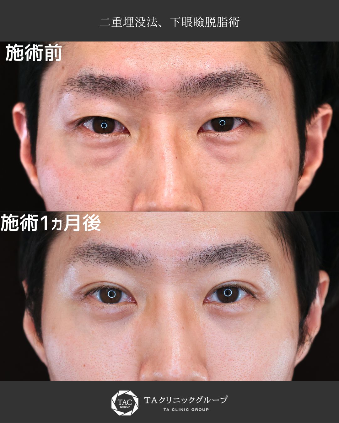 下眼瞼切開術（クマ・たるみとり）/下眼瞼脱脂術（目の下のたるみ取り・目の下の脂肪ふくらみ取り）/二重埋没法の症例写真 施術前後 