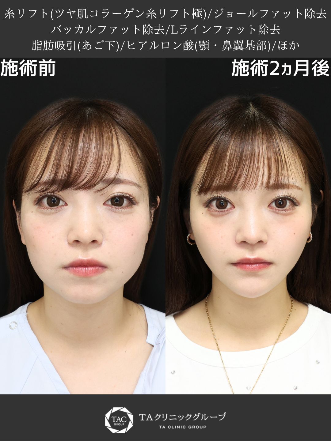 TAC式 ツヤ肌コラーゲンリフト®/バッカルファット除去/ジョールファット除去の症例写真 施術前後 