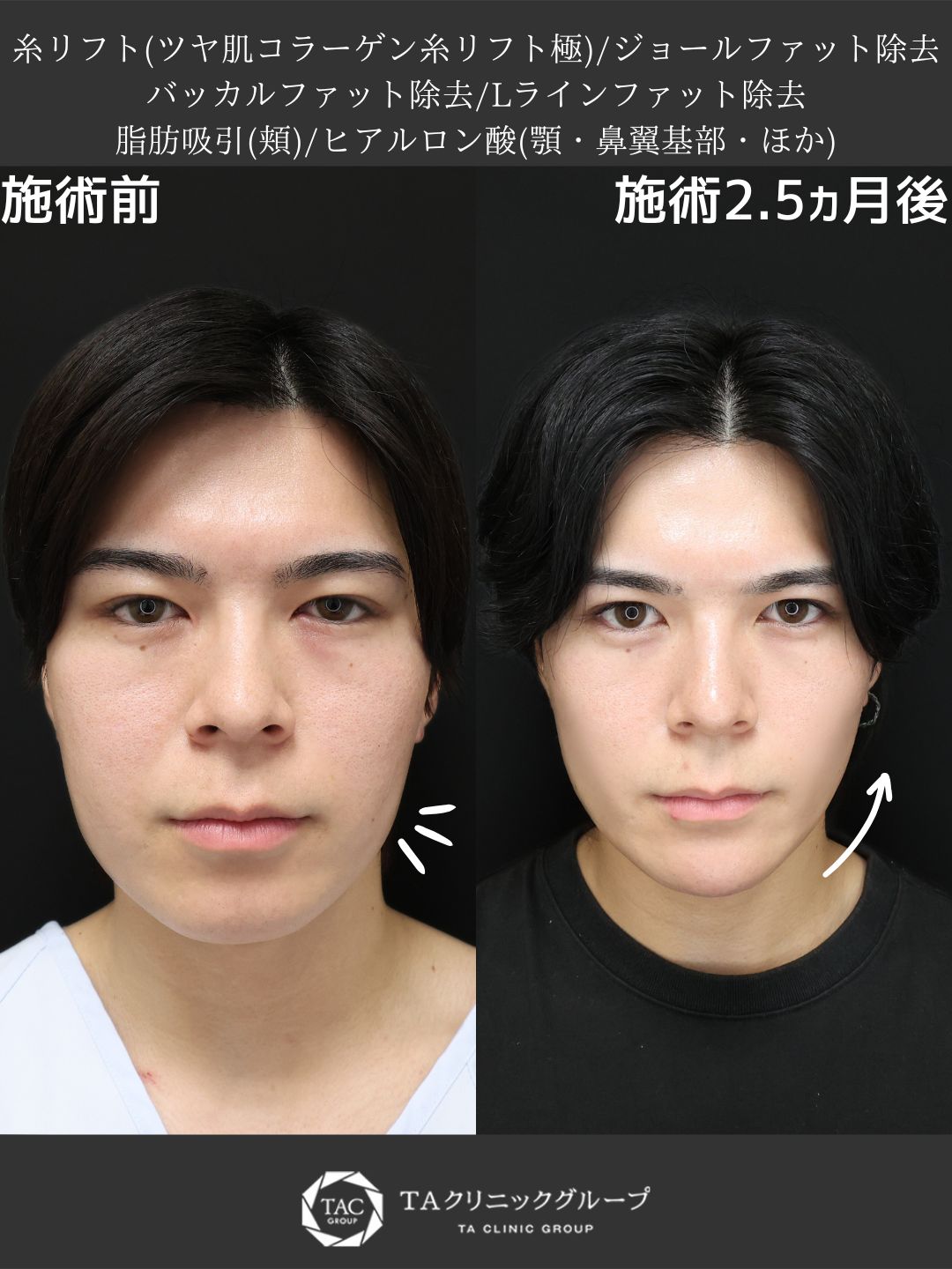 TAC式 ツヤ肌コラーゲンリフト®/Lラインファット除去（エラ下脂肪除去）/ジョールファット除去の症例写真 施術前後 