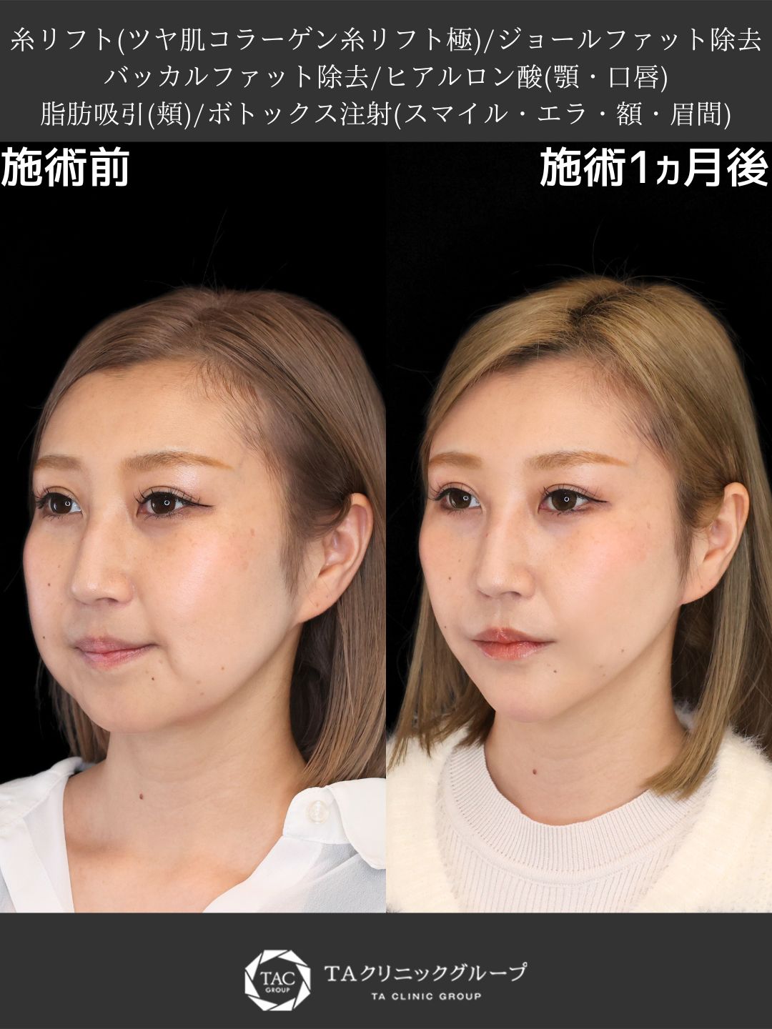 TAC式 ツヤ肌コラーゲンリフト®/ジョールファット除去/バッカルファット除去の症例写真 施術前後 