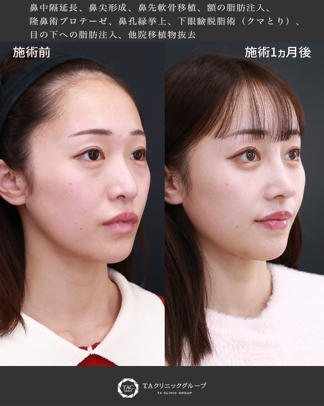 下眼瞼脱脂術（目の下のたるみ取り・目の下の脂肪ふくらみ取り）/隆鼻術（プロテーゼ・自家組織）/顔の脂肪注入(コンデンスリッチフェイス)の症例写真 施術前後 