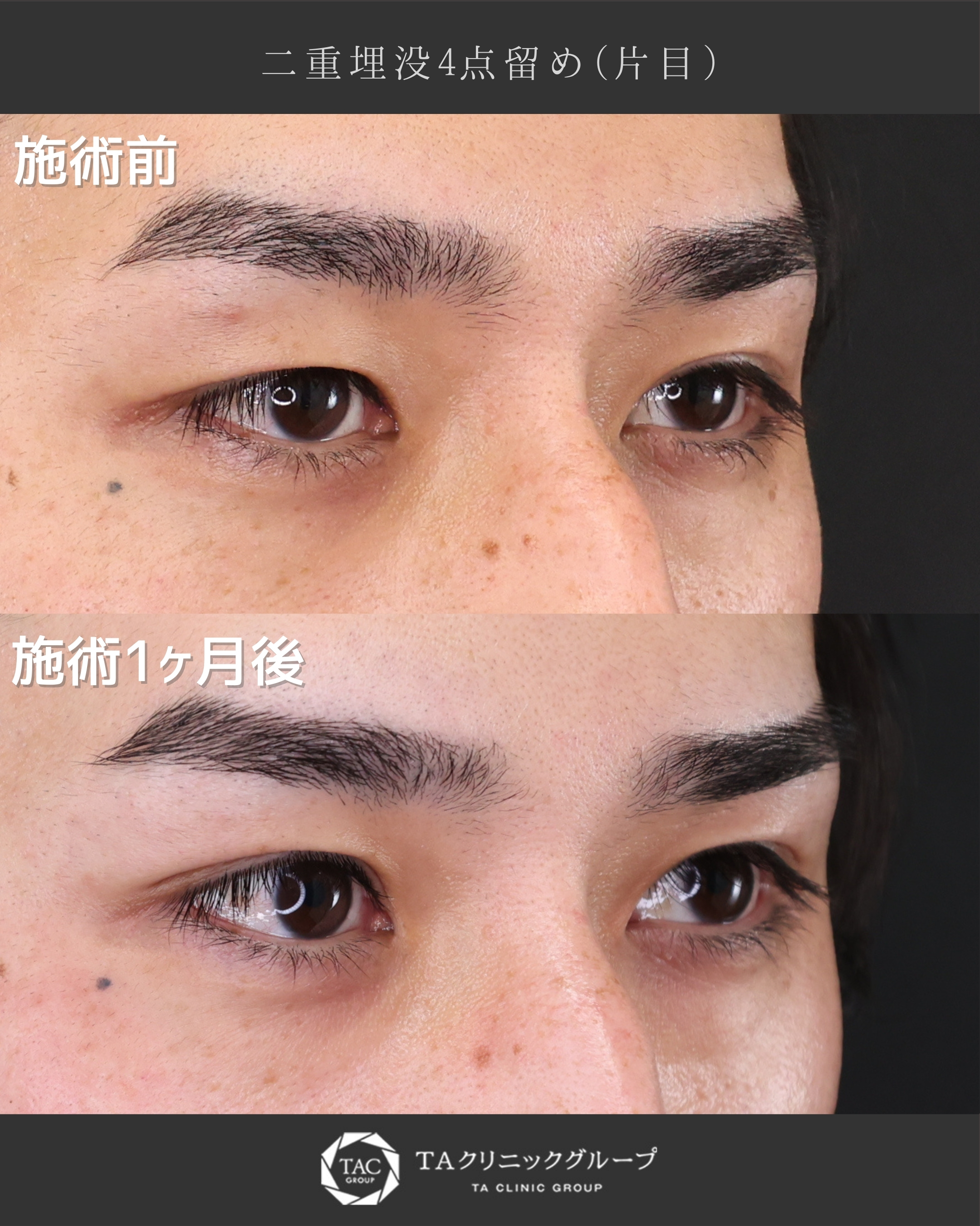 二重埋没法/片目二重術（片目だけ整形したい方）の症例写真 施術前後 