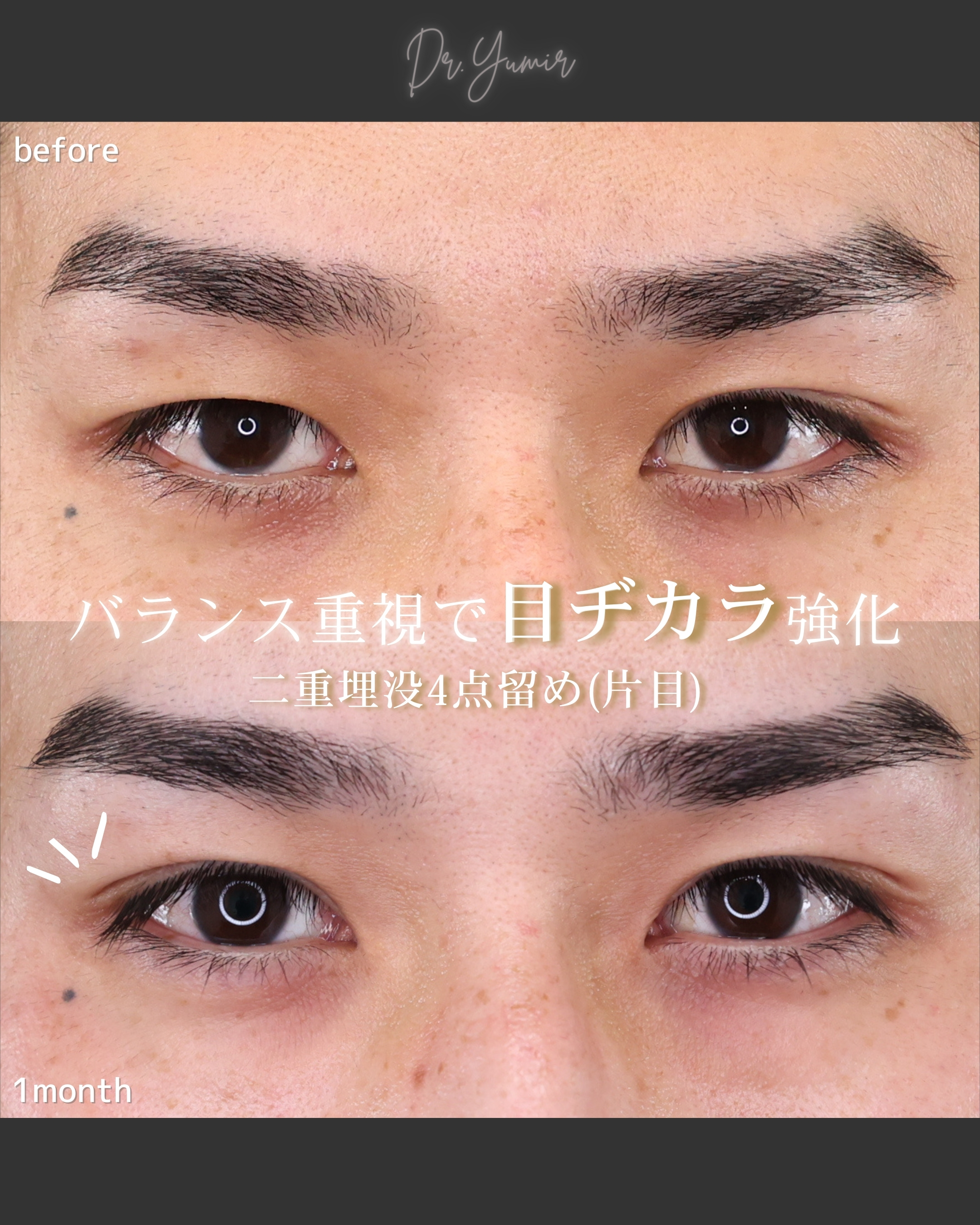 二重埋没法/片目二重術（片目だけ整形したい方）の症例写真 施術前後 