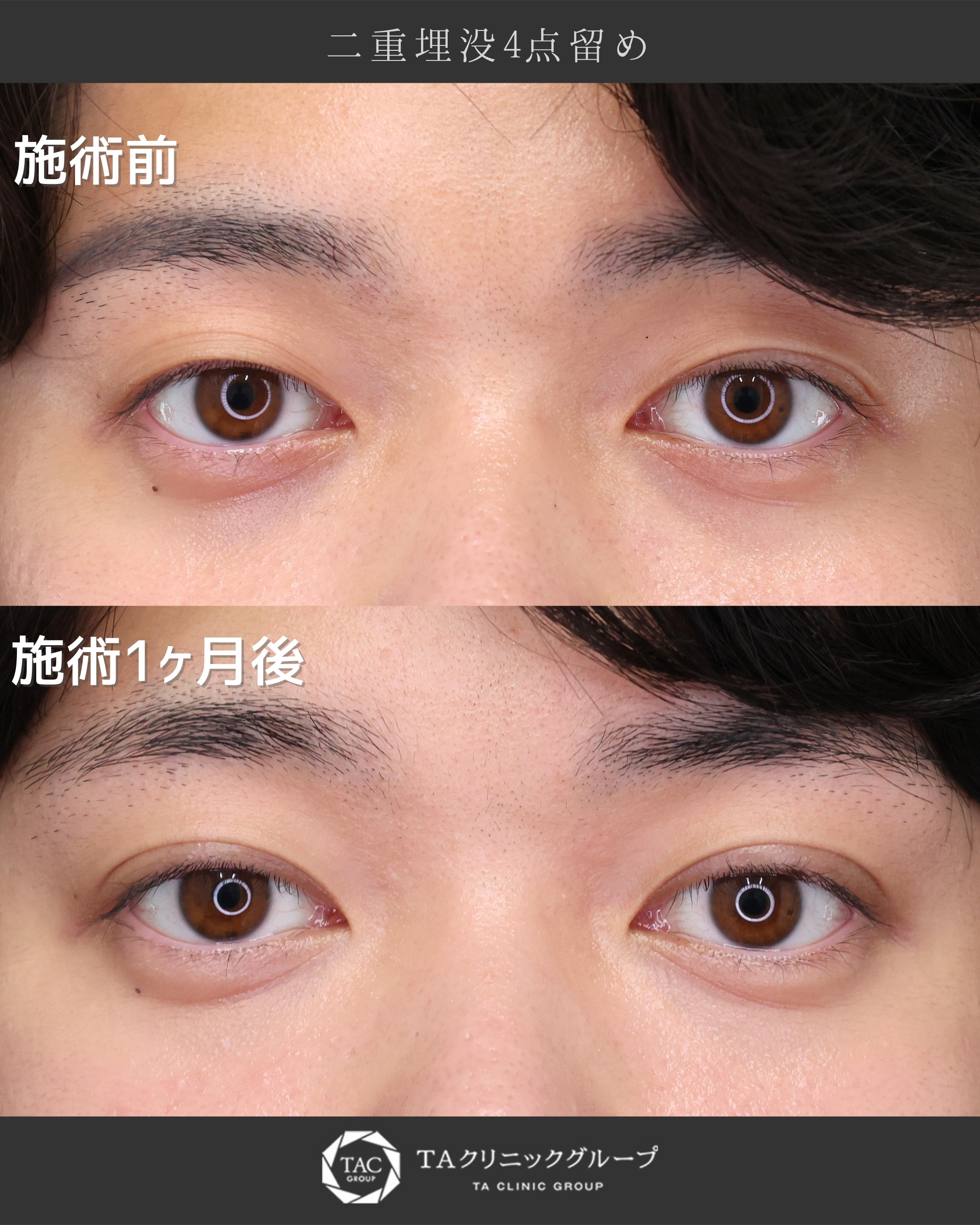 二重埋没法の症例写真 施術前後 