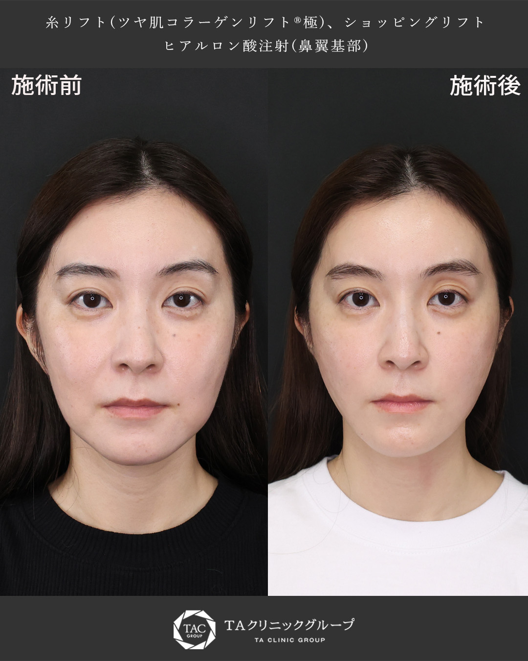 TAC式 ツヤ肌コラーゲンリフト®/TAC式 ショッピングリフト/ヒアルロン酸注射：その他の症例写真 施術前後 