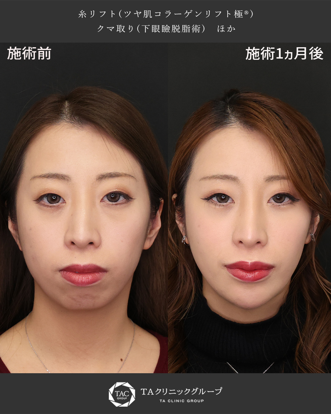 TAC式 ツヤ肌コラーゲンリフト®/下眼瞼脱脂術（目の下のたるみ取り・目の下の脂肪ふくらみ取り）/おでこ・こめかみのヒアルロン酸注射の症例写真 施術前後 