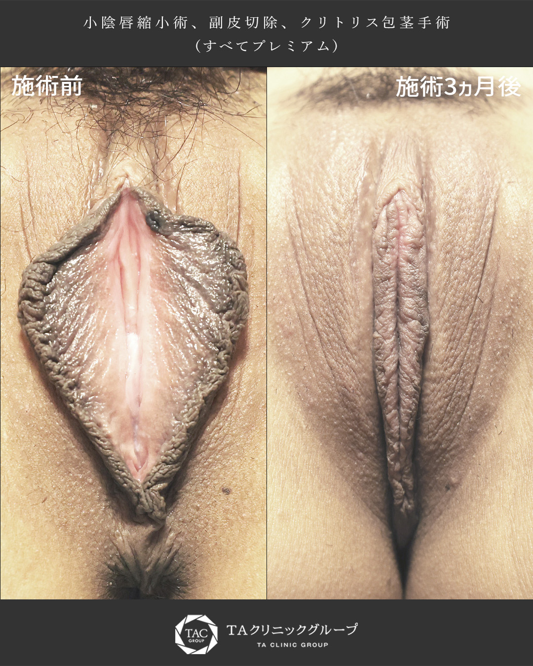 TAC式小陰唇縮小術（ヴィーナスシルエット）/副皮切除/クリトリス包茎手術の症例写真 施術前後 