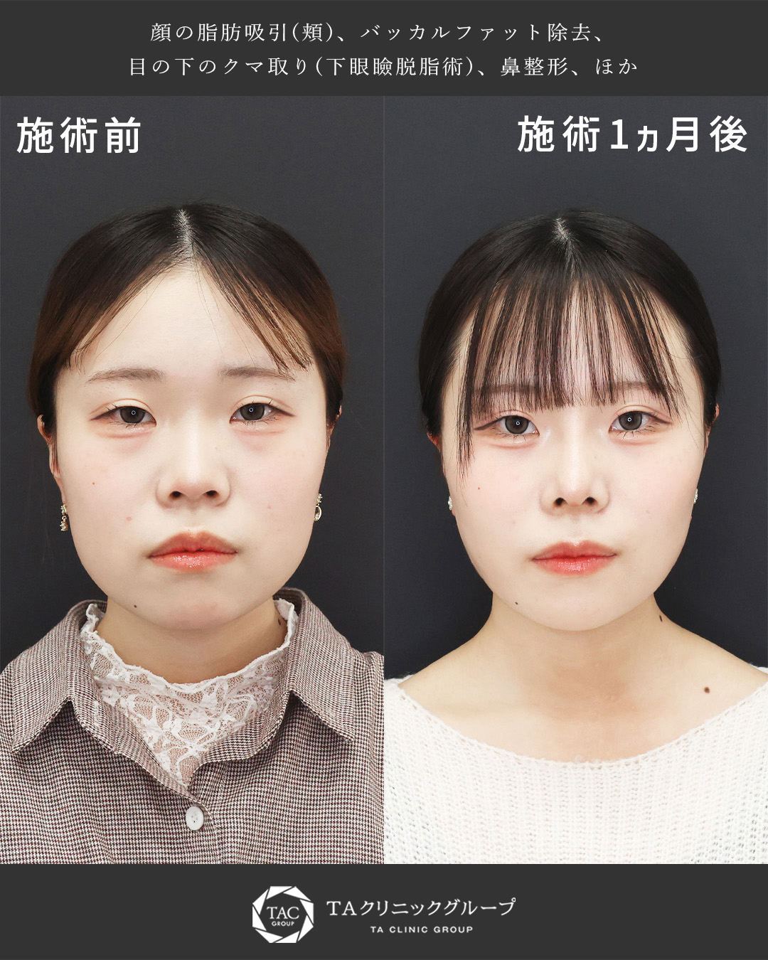 顎下の脂肪吸引/バッカルファット除去/TAC式 ツヤ肌コラーゲンリフト®の症例写真 施術前後 