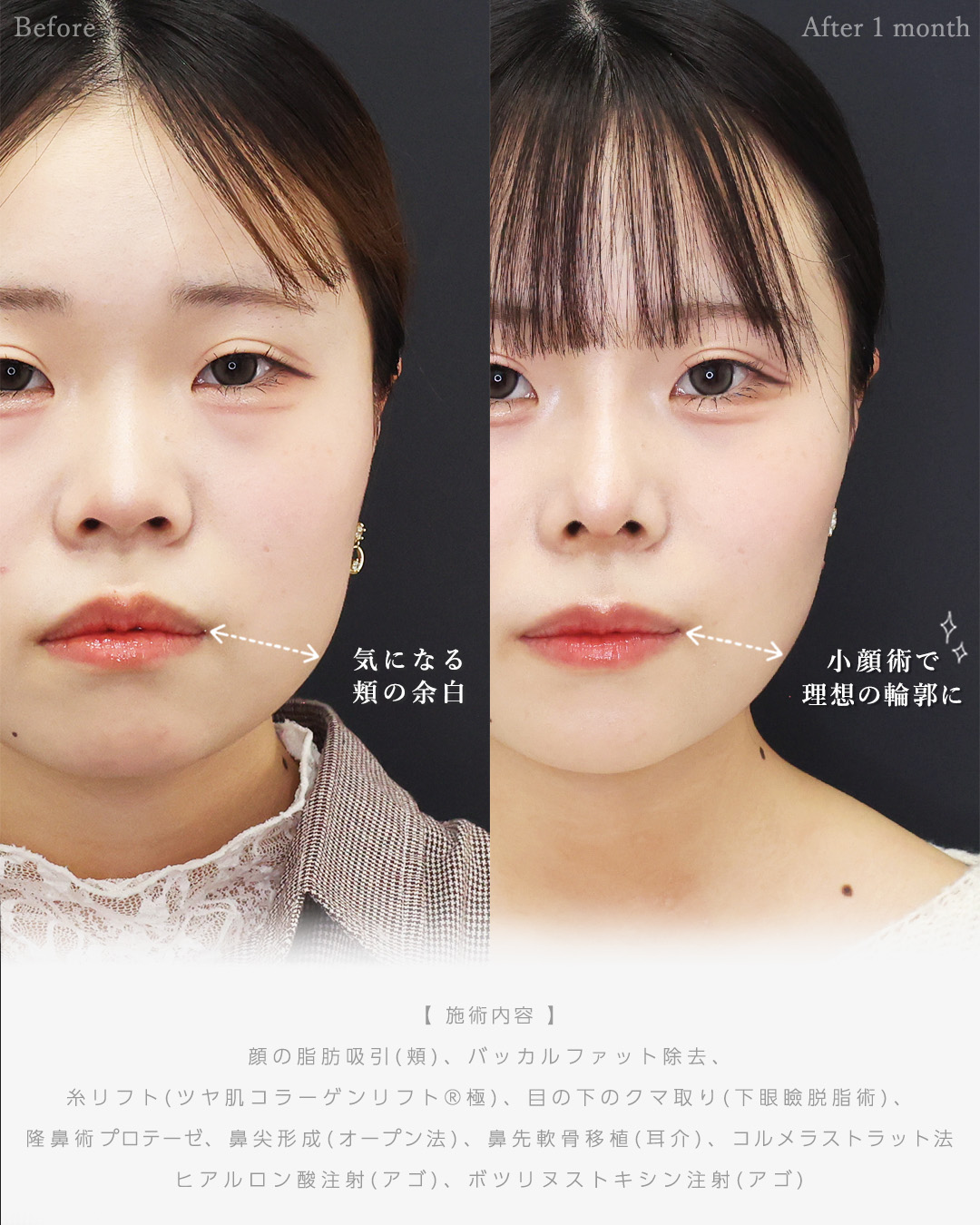 顎下の脂肪吸引/バッカルファット除去/TAC式 ツヤ肌コラーゲンリフト®の症例写真 施術前後 
