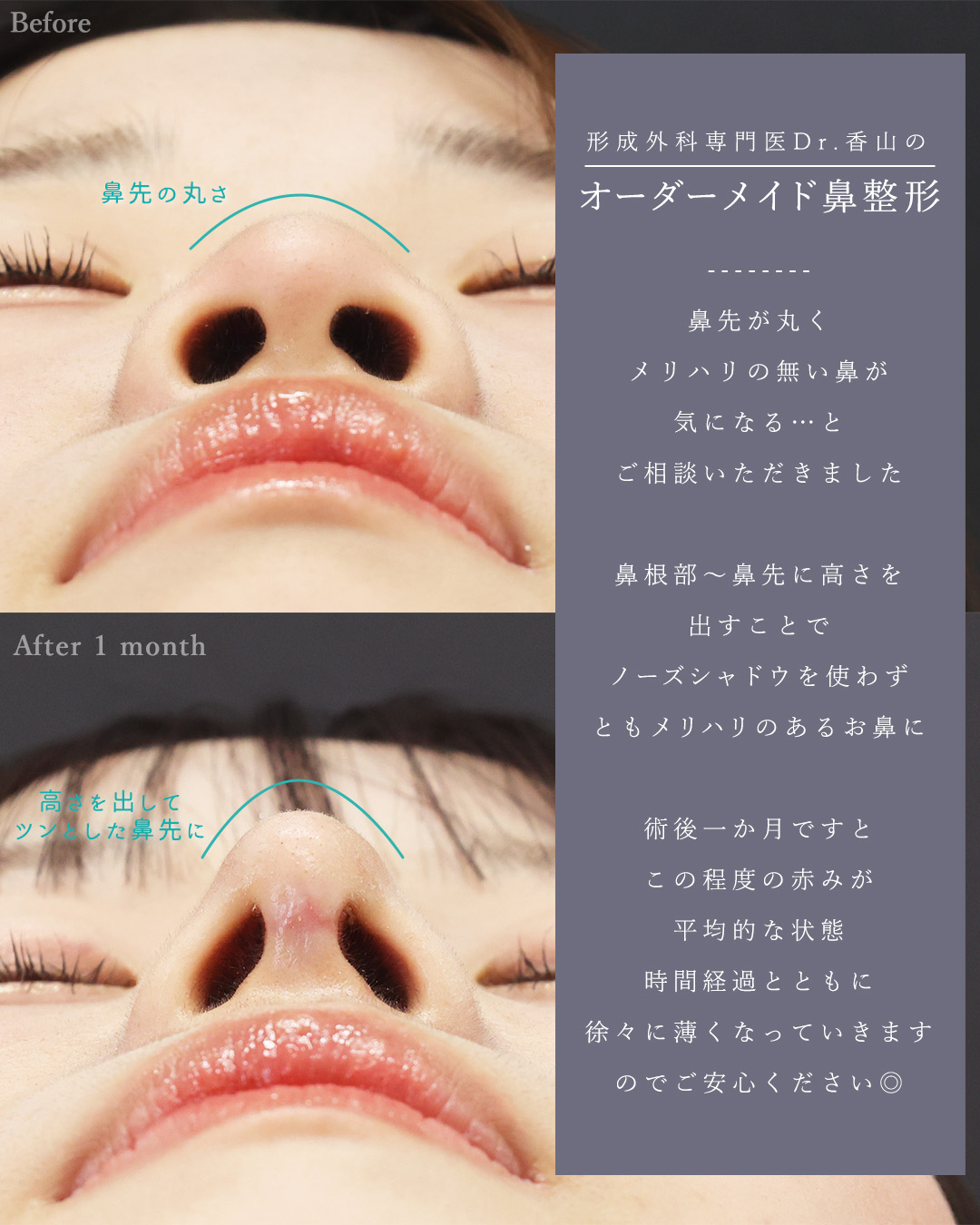 顎下の脂肪吸引/バッカルファット除去/TAC式 ツヤ肌コラーゲンリフト®の症例写真 施術前後 