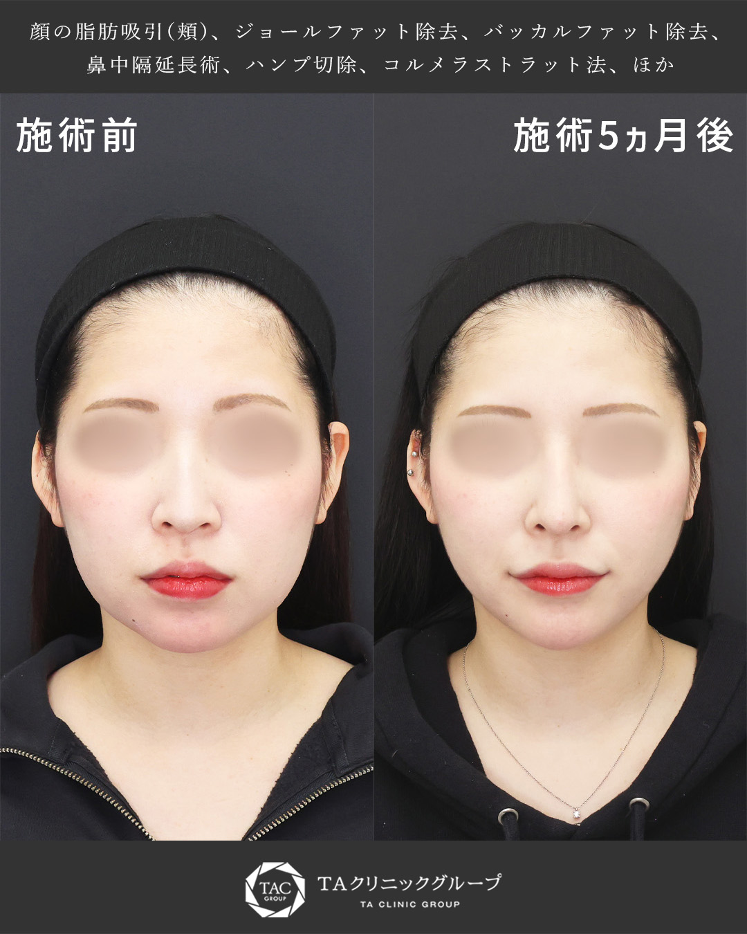鼻中隔延長術/顎下の脂肪吸引/ジョールファット除去の症例写真 施術前後 
