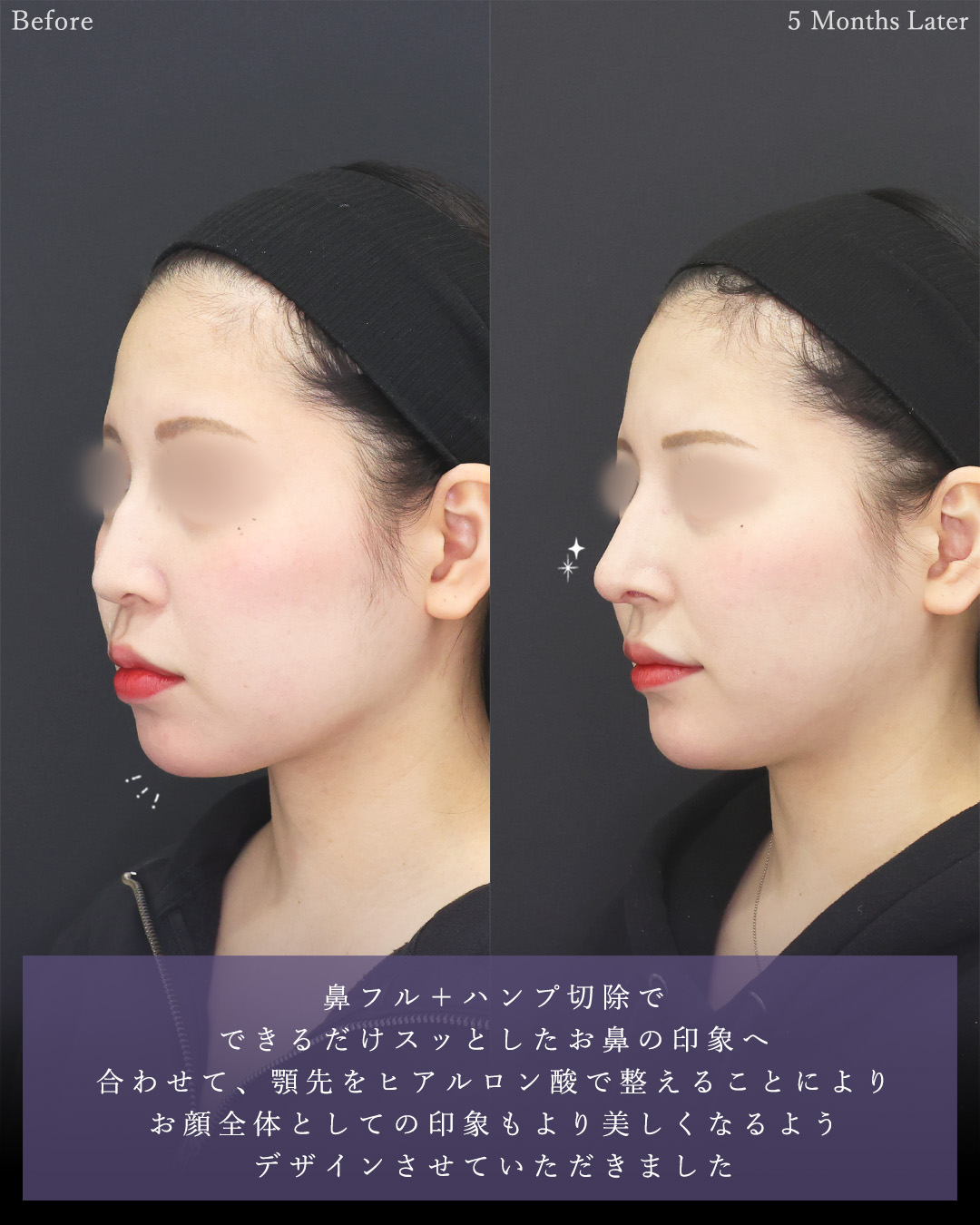 鼻中隔延長術/顎下の脂肪吸引/ジョールファット除去の症例写真 施術前後 