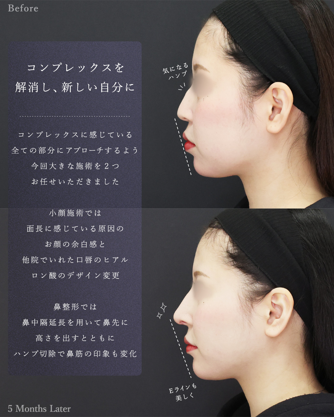 鼻中隔延長術/顎下の脂肪吸引/ジョールファット除去の症例写真 施術前後 