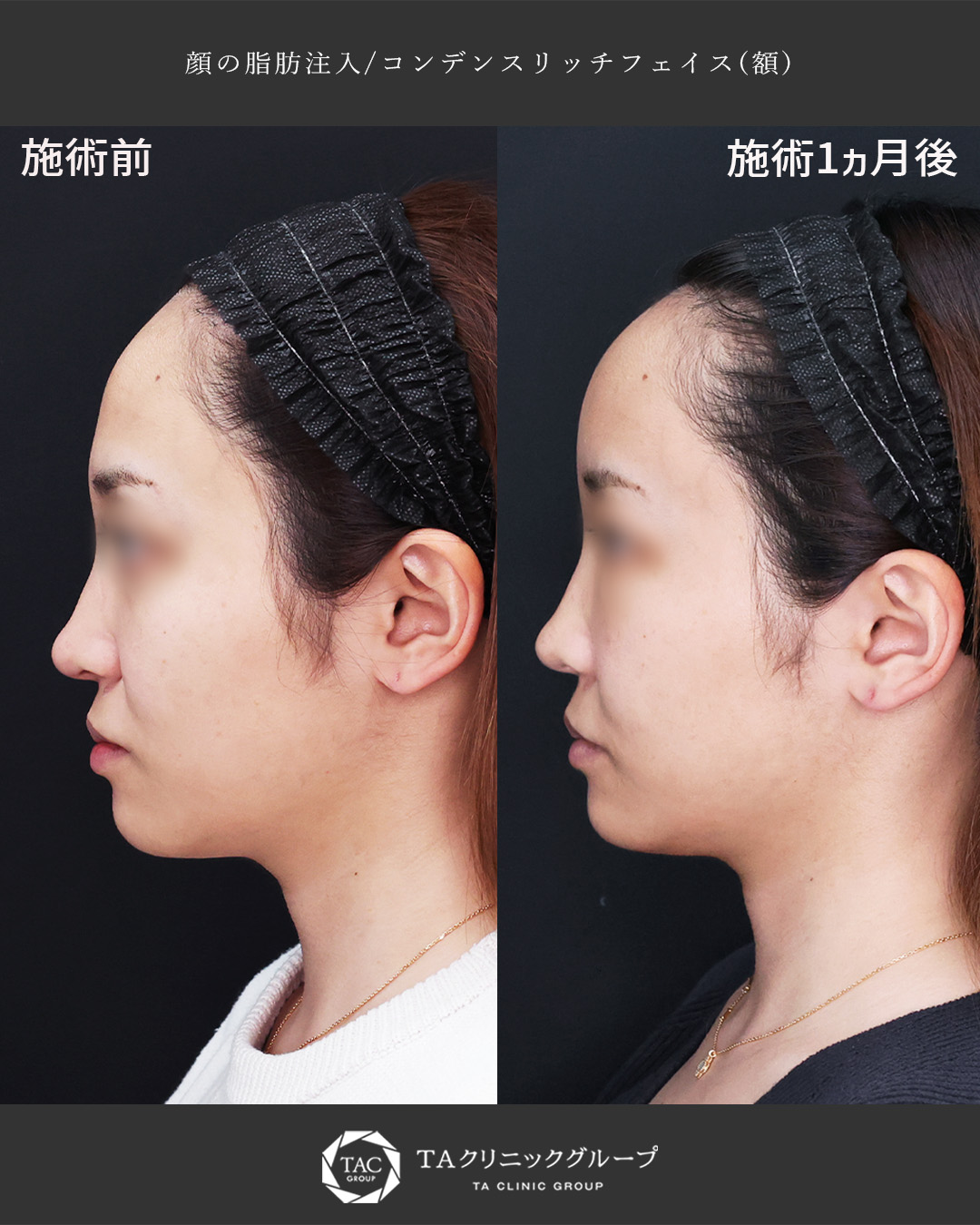 おでこの脂肪注入（オルチャンデコ形成）の症例写真 施術前後 